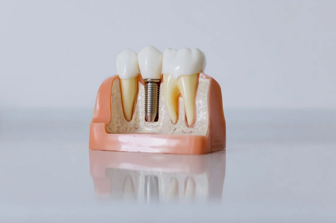 implant